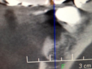 下顎インプラントの垂直的GBRを用いた症例
