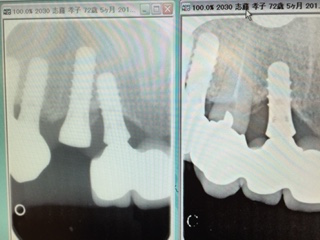 抜歯同時のインプラント治療