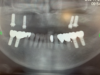 総義歯（入れ歯）のインプラント治療